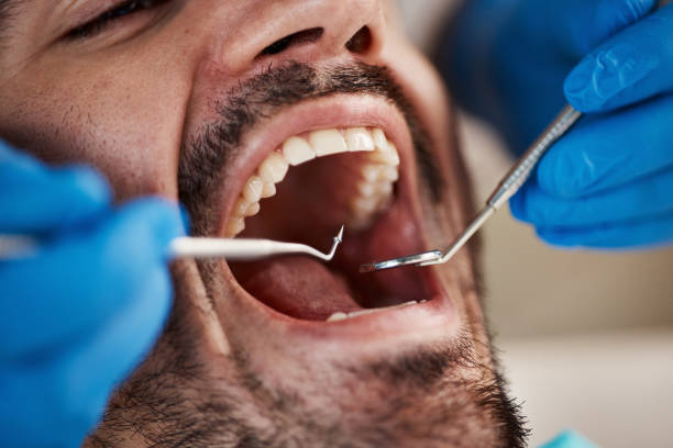 Best Emergency Wisdom Tooth Extraction in Kitsap Lake, WA