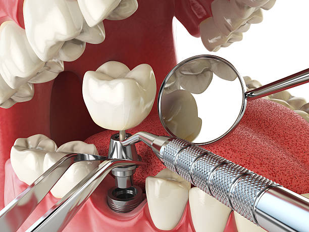 Best Knocked-Out Tooth (Avulsed Tooth) Treatment in Kitsap Lake, WA