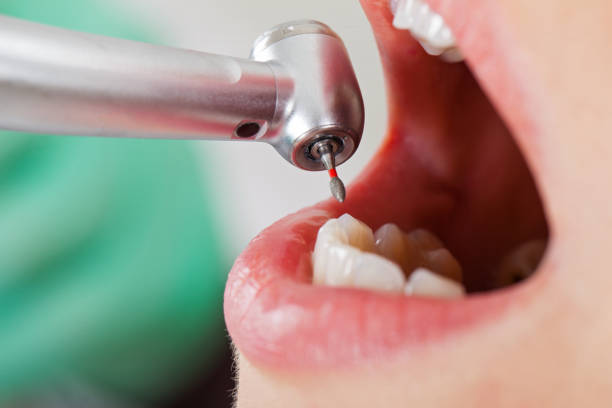 Best Emergency Denture Repair in Kitsap Lake, WA
